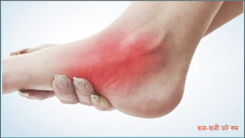 করোনা আক্রান্তের চিহ্ন এখন পায়েও