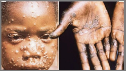 এবার দক্ষিণ আফ্রিকায় প্রাণঘাতী বানর ফক্সের হানা, ১০ জনের মৃত্যু আক্রান্ত ১৪১